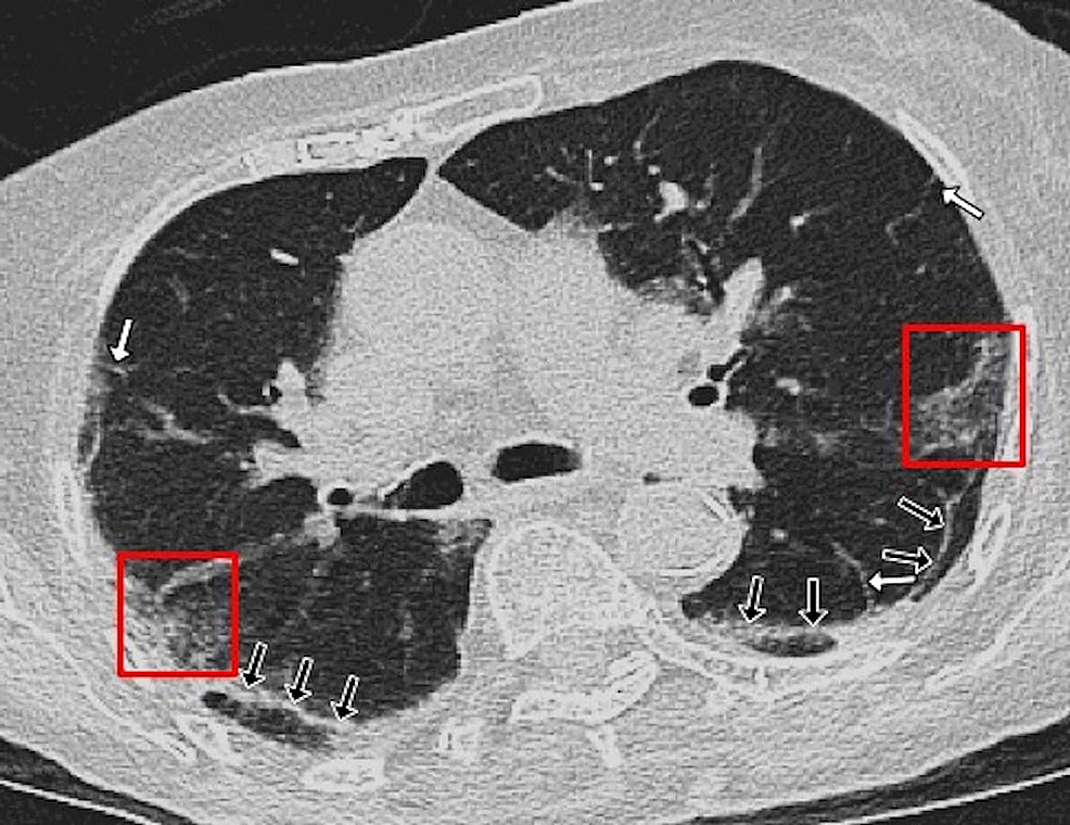 A-67-year-old-female-patient-with-positive-RT-PCR-test-for-COVID-19