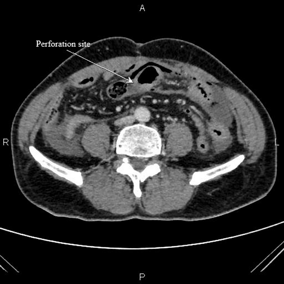 腺結核における穿孔腹膜炎を引き起こす血管炎の全身性エリテマトーデス血管炎：変装した疾患
