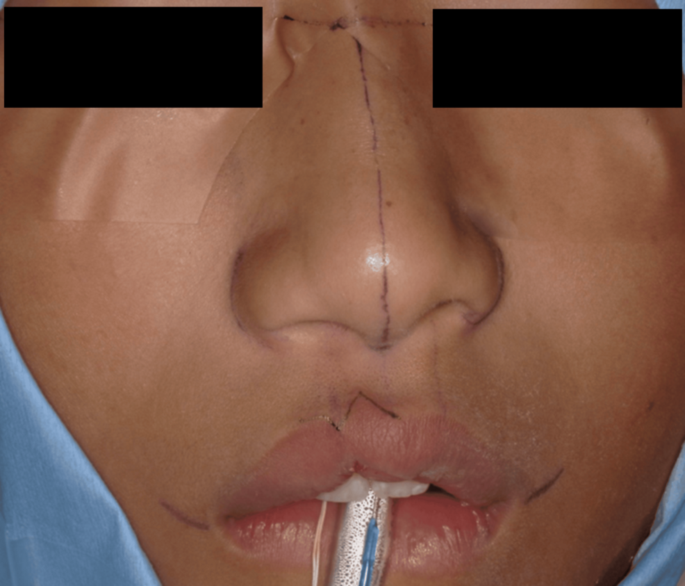 Aesthetic and Functional Surgical Management of Microform Cleft Lip With a Vermilion Border Incision