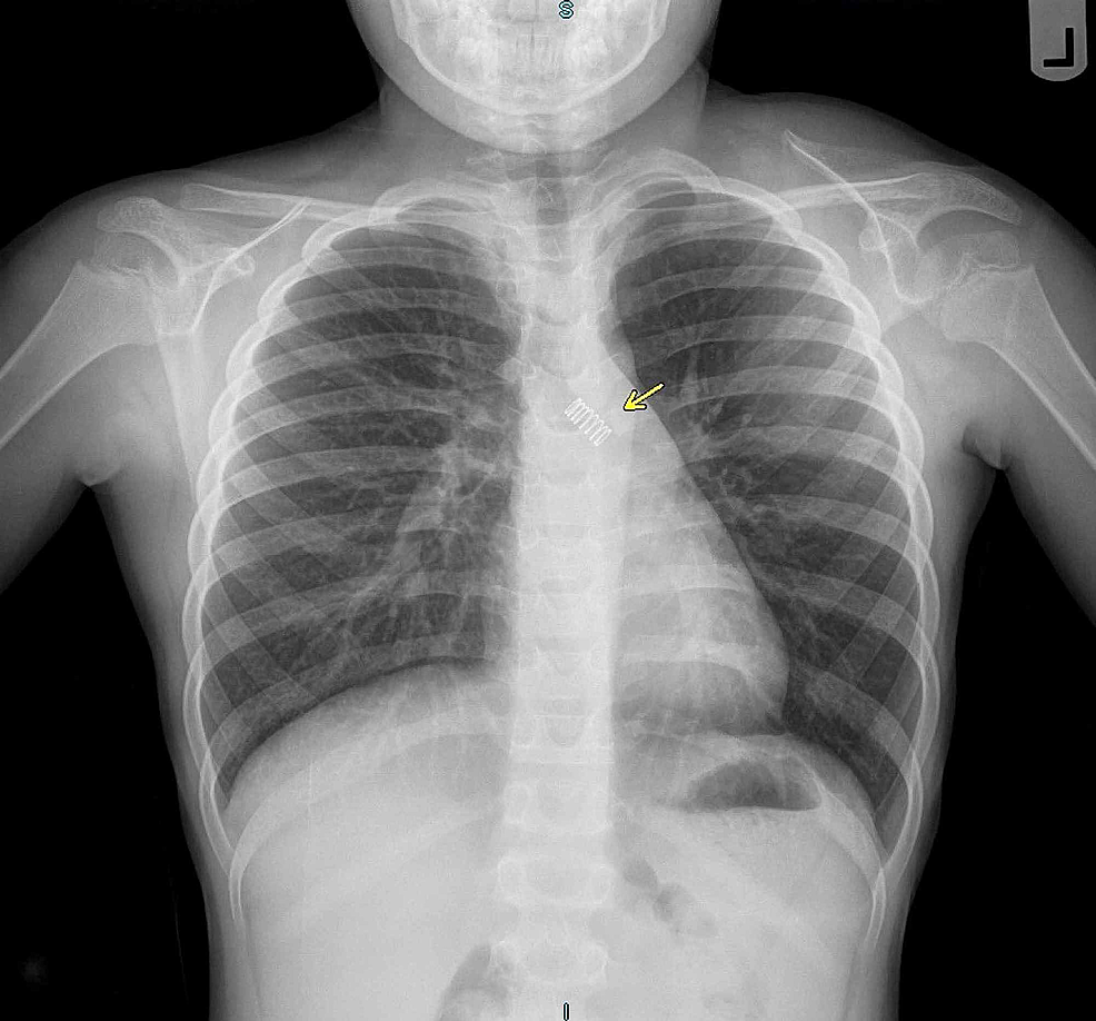A Case of Pediatric Aspiration of a Metallic Spring Cureus