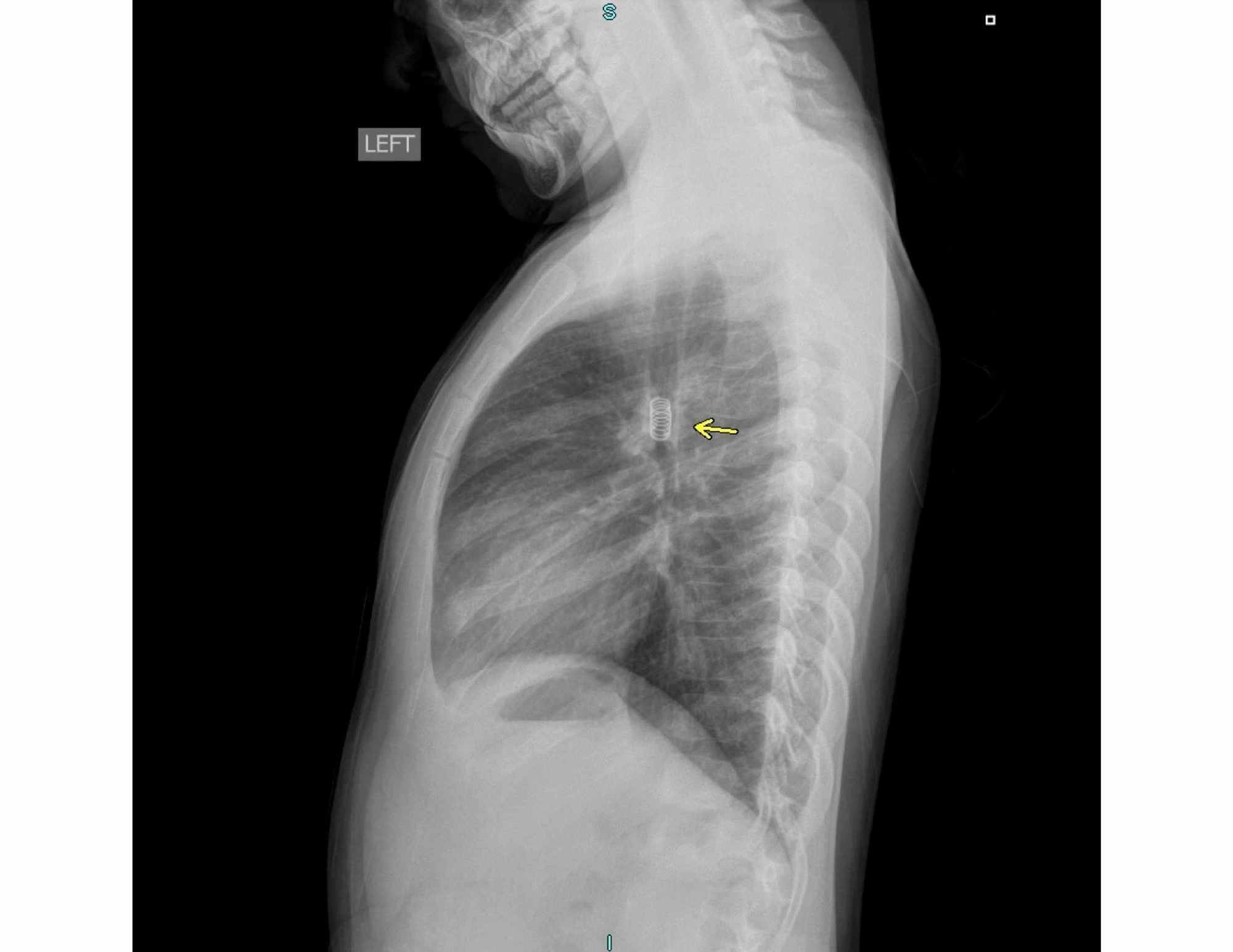 Cureus | A Case Of Pediatric Aspiration Of A Metallic Spring Cureus | A Case Of Pediatric Aspiration Of A Metallic Spring