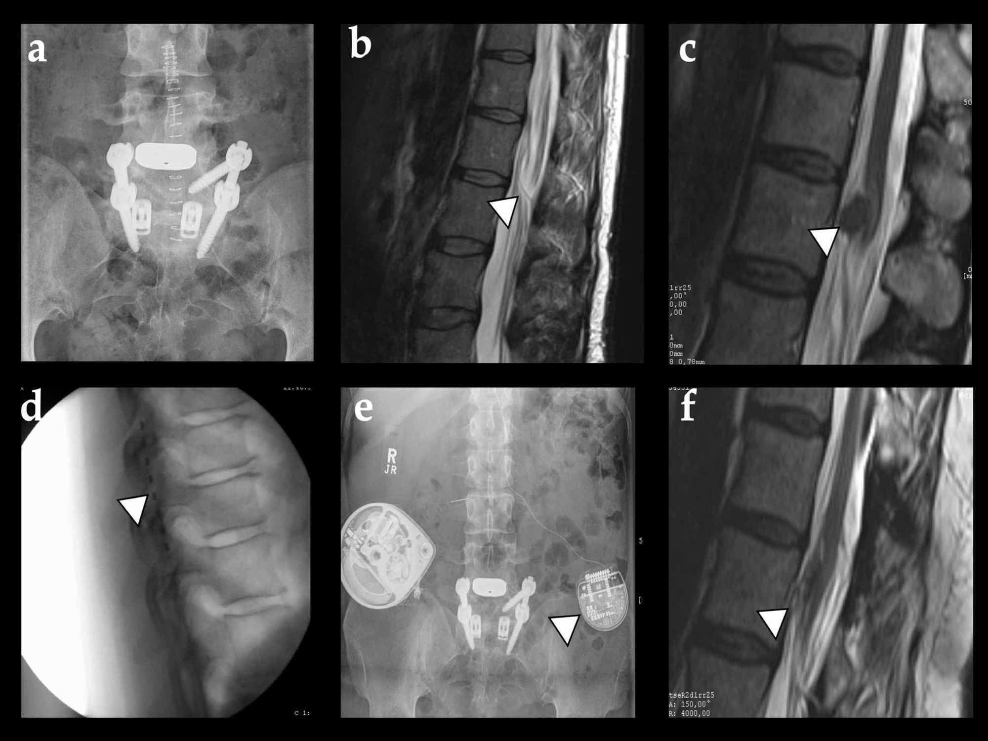 Cureus | The Management of Unresectable Intrathecal Catheter-Tip ...