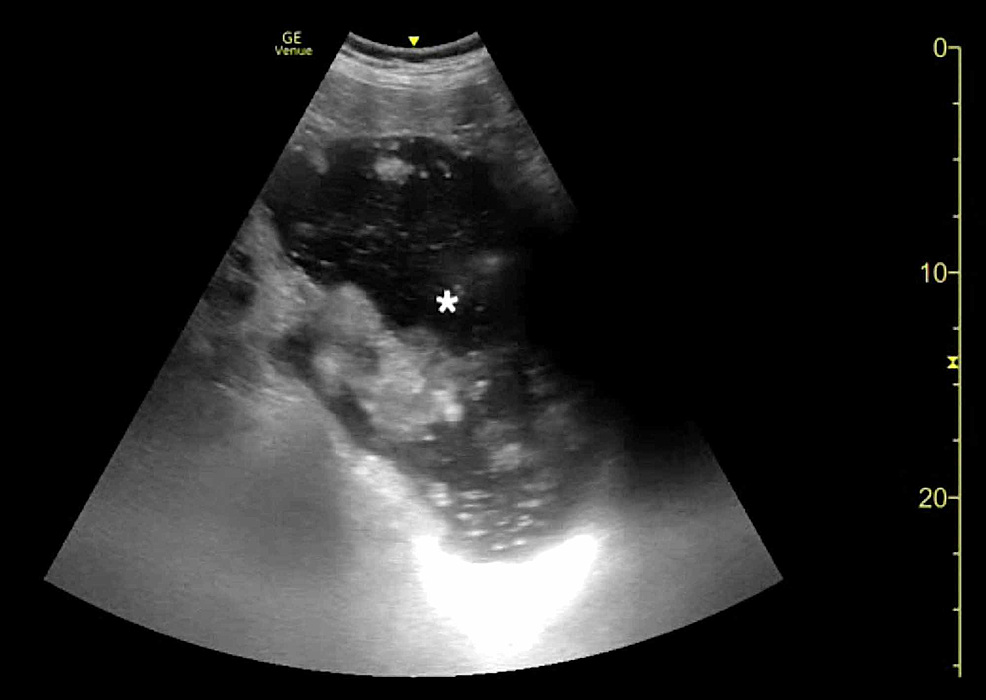 Emergency Physician-Performed Bedside Ultrasound Of Gastric Volvulus ...