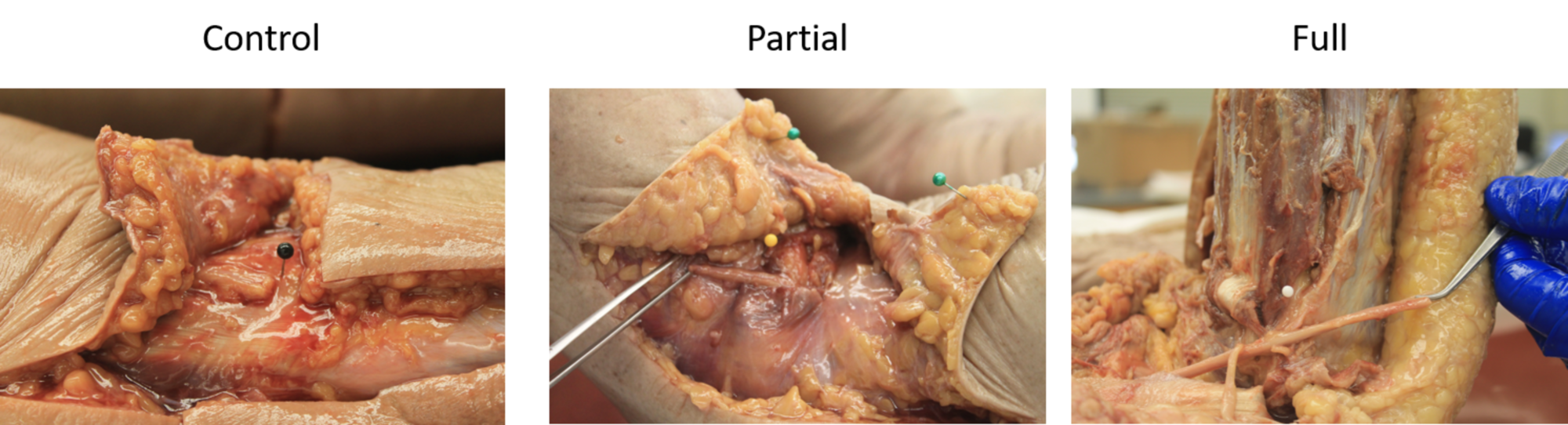 common peroneal neuropathy