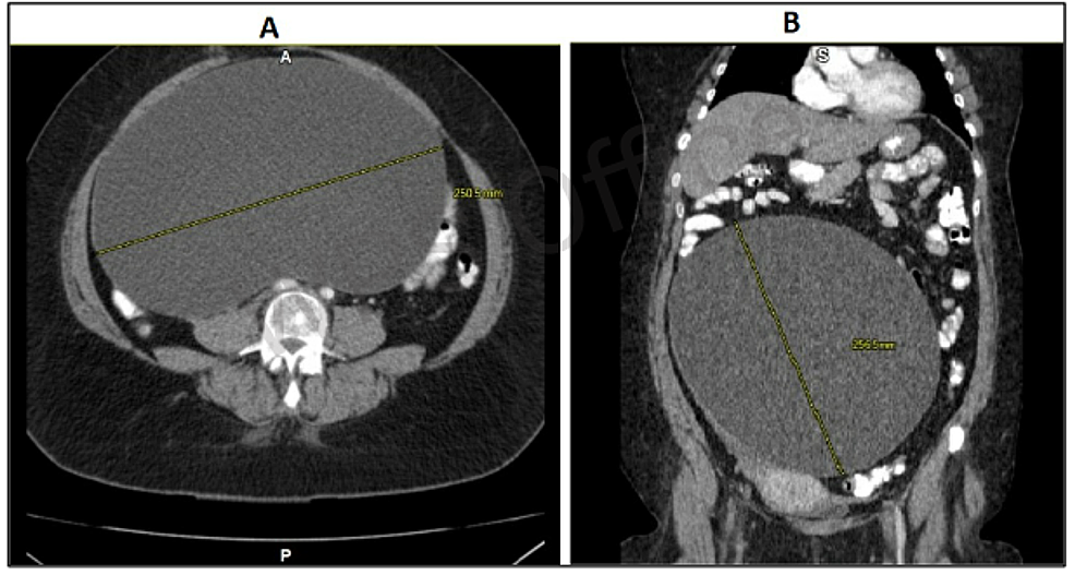 Abdominal-CT-in-axial-(A)-and-coronal-(B)-sections-showing-large,-well-defined,-unilocular-cystic-mass-measuring-25-×-25-cm.