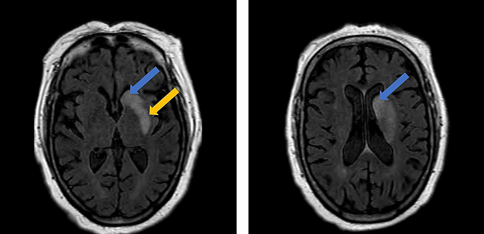 MRI-showing-an-acute/sub-acute-infarct-involving-the-left-caudate-nucleus-(blue-arrow)-and-putamen-(yellow-arrow).