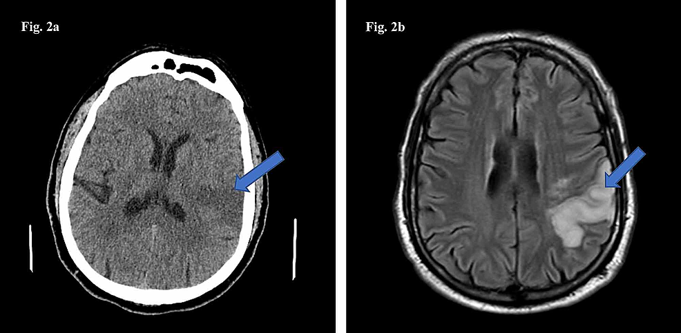 CT-scan-of-the-head-(2a)-and-MRI-of-the-brain-(2b)-showing-an-evolving-moderate-sized-subacute-left-MCA-branch-infarct-(arrows).