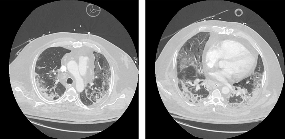 Chest-CT-illustrating-diffuse-bilateral-ground-glass-consolidation-of-lungs.