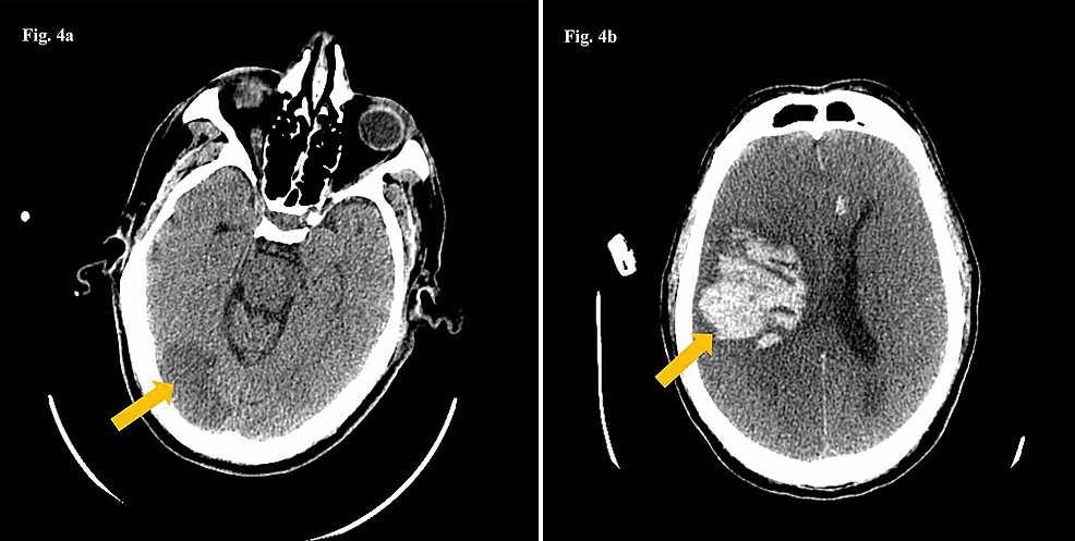 CT-scan-of-the-head-with-a-low-density-area-in-the-right-occipital-lobe-(4a)-consistent-with-a-subacute-ischemic-stroke-(arrow);-and-right-intraparenchymal-hematoma-(arrow)-with-midline-shift-with-compression-of-the-lateral-ventricle-and-scattered-subarachnoid-hemorrhage-(4b).