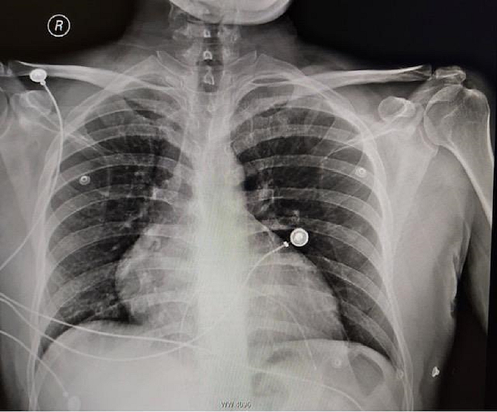 A-chest-x-ray-revealed-normal-findings-with-normal-cardiac-shadow-and-lung-fields.