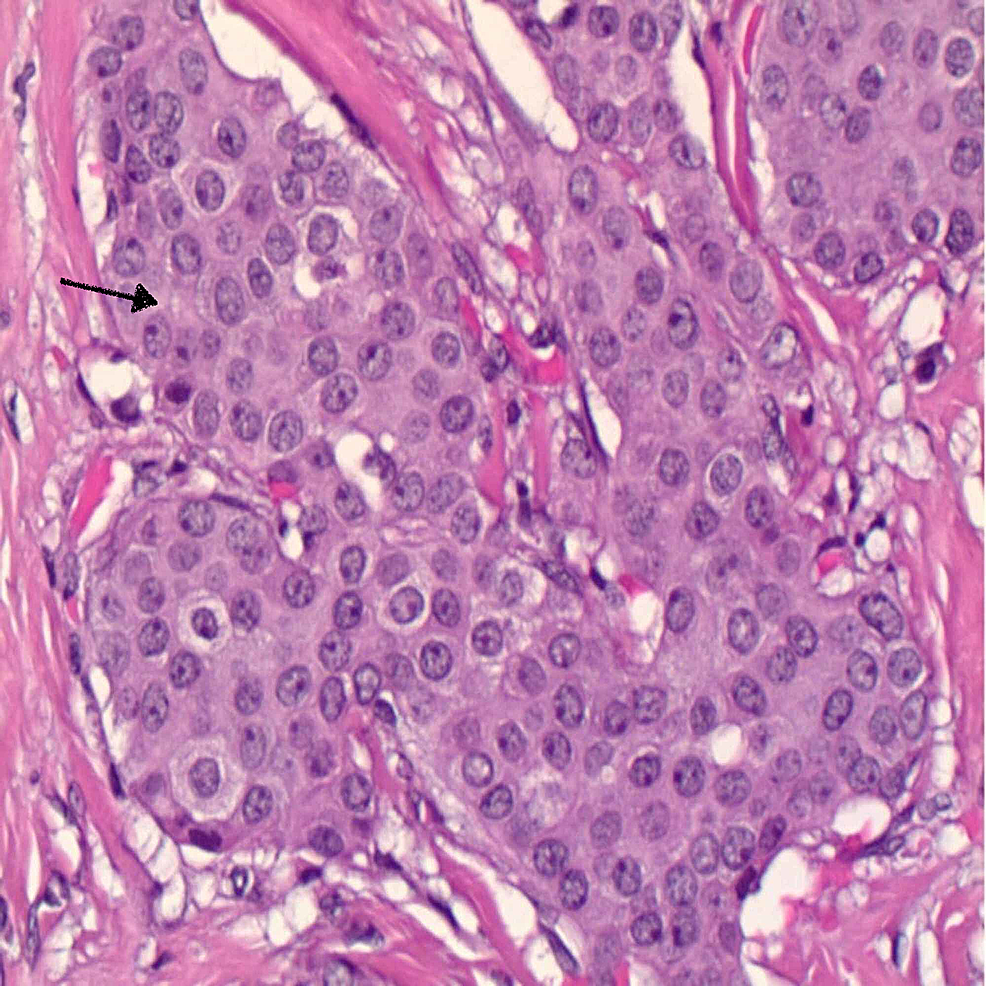 Cureus A Rare Presentation of an Invasive Ductal Carcinoma of Ectopic