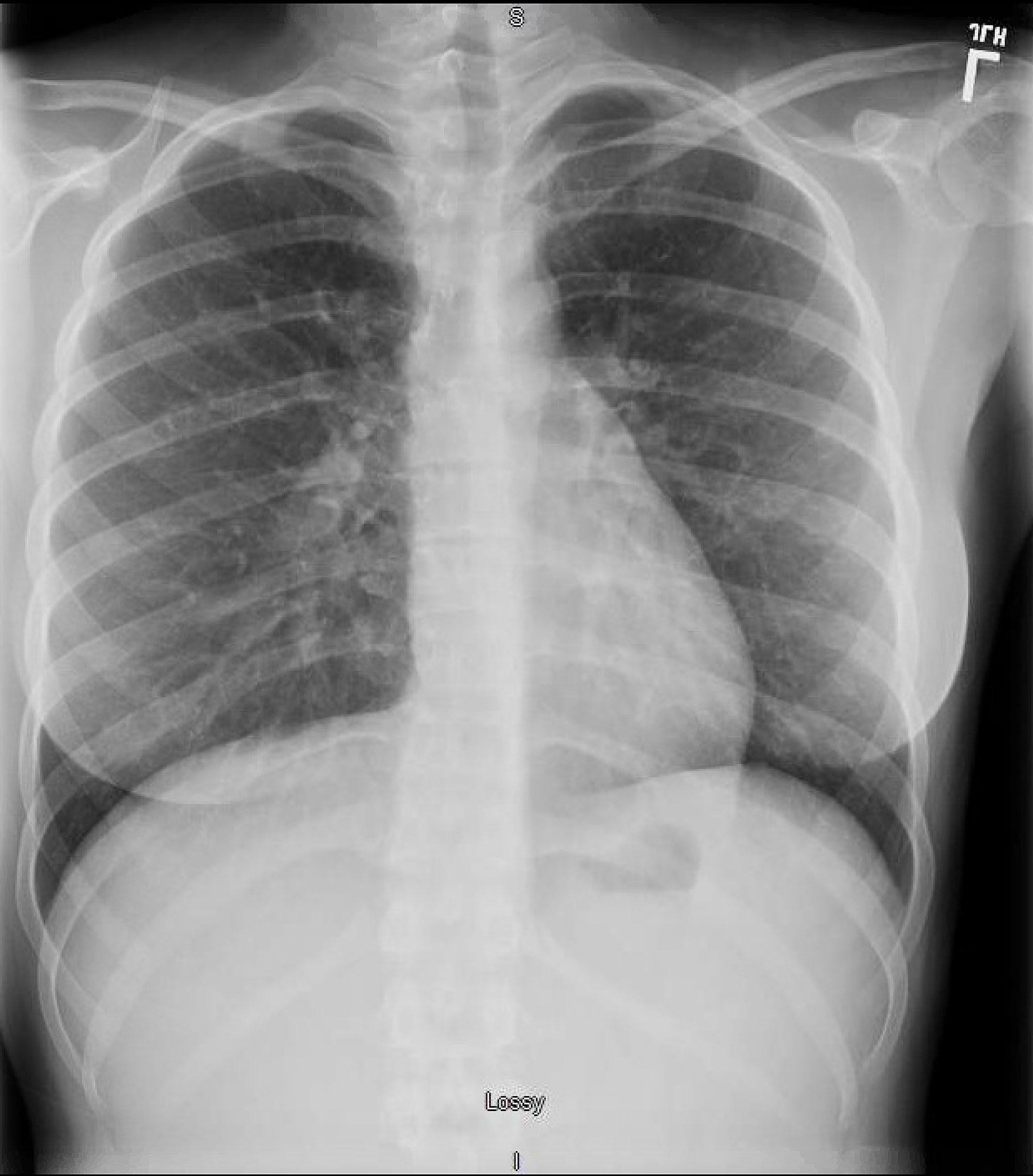 Cureus | A Challenging Case of Lemierre’s Syndrome With Central Nervous ...