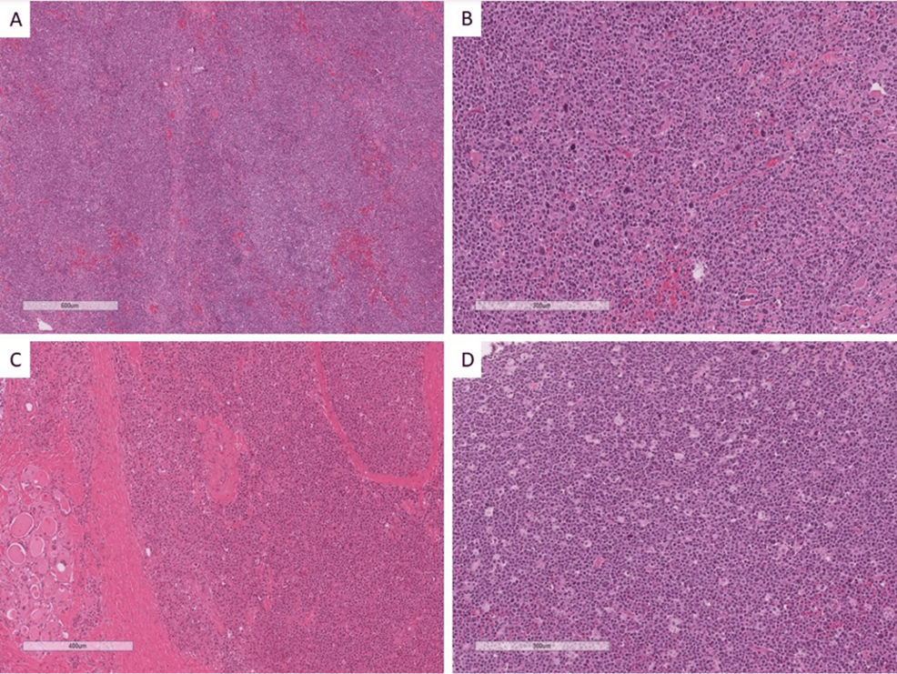 甲状腺リンパ腫の病理学的所見、臨床的特徴、および結果：単一の三次ケア病院の経験