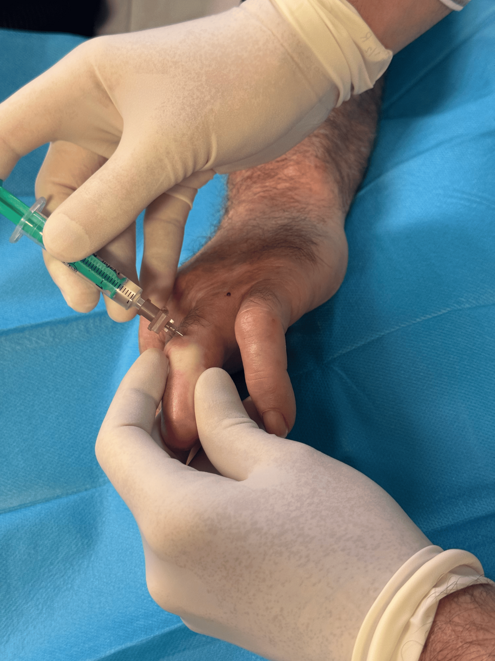 Injection-of-botulinum-toxin-type-A-in-Case-1-patient.