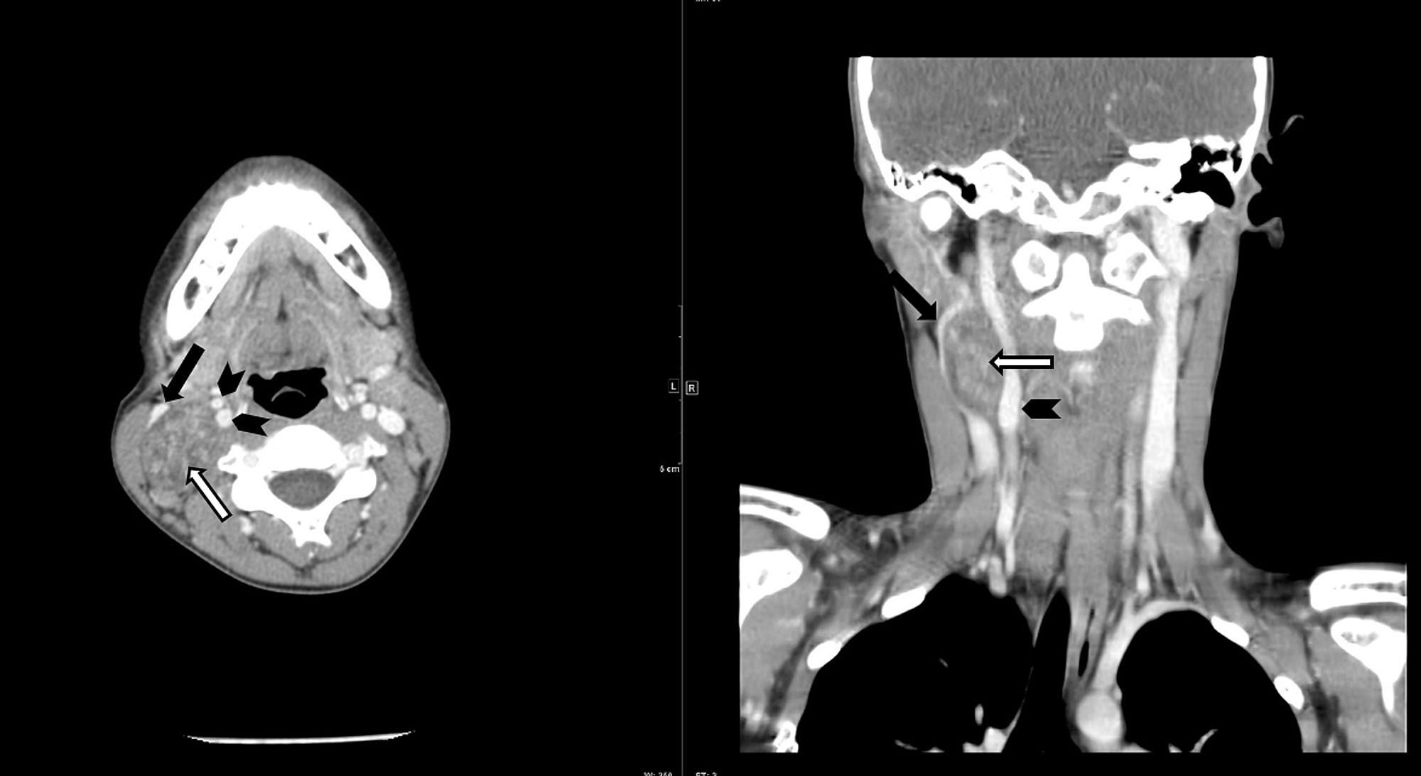 Cureus Multimodal Imaging Characteristics And Diagnostic Approach To Ancient Schwannoma In A 9088