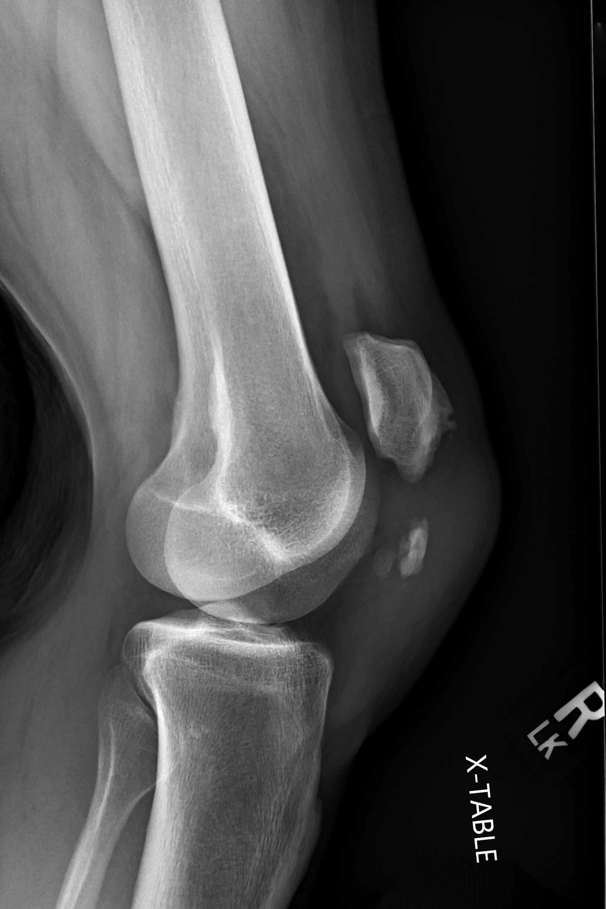 Cureus Simultaneous Bilateral Patellar Tendon Rupture in a Young