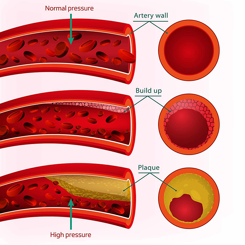 Blood-vessel-wall-in-response-to-high-pressure