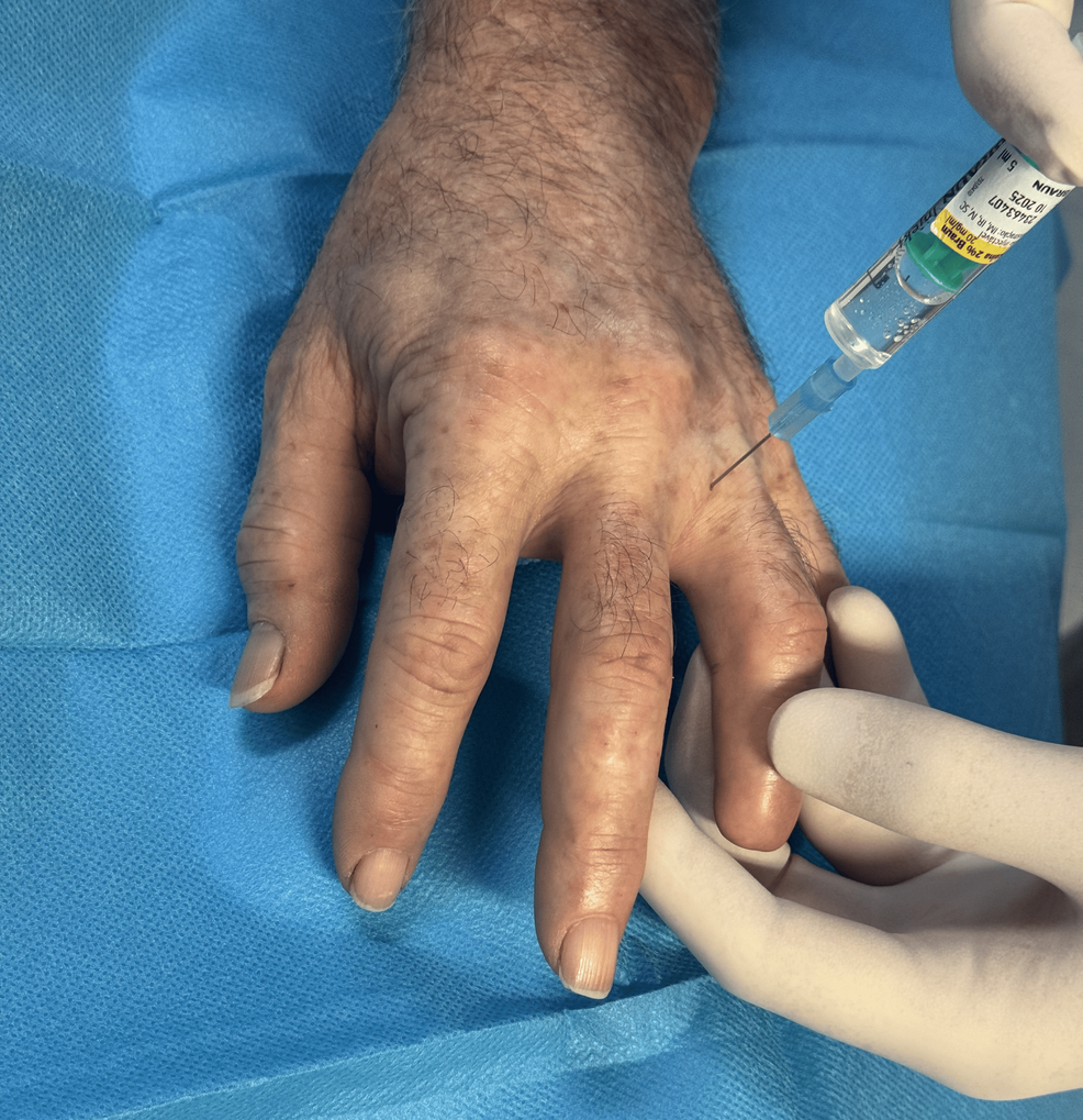 Digital-nerve-block-performed-before-botulinum-toxin-injection-into-the-painful-area-in-Case-1-patient.