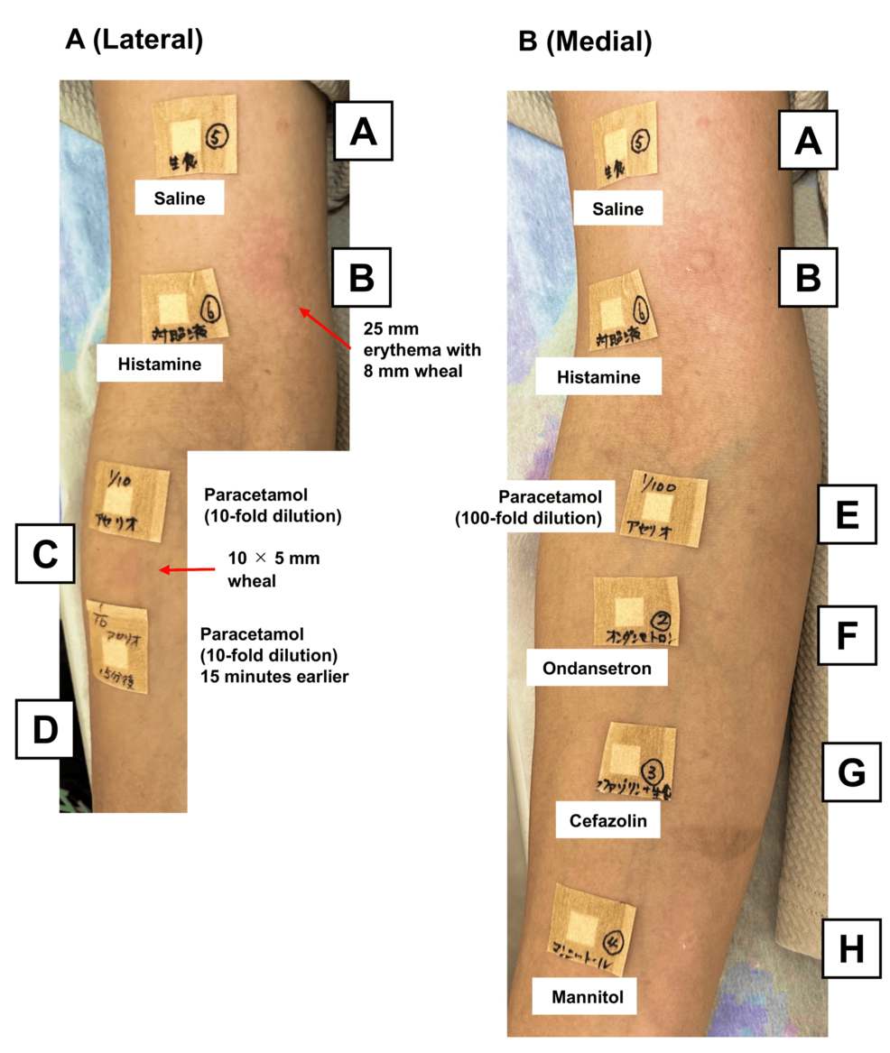 -Results-of-skin-prick-testing-for-suspected-perioperative-allergens