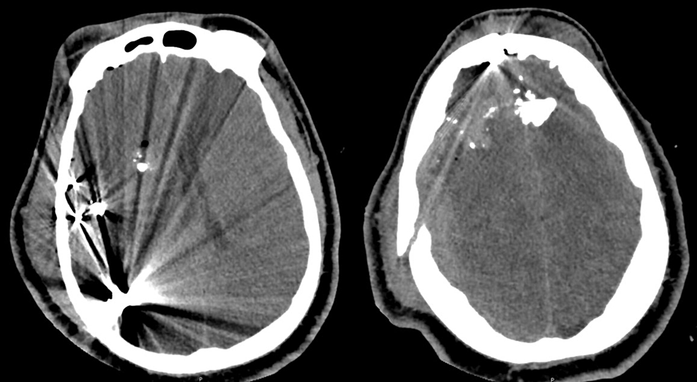 cureus-a-case-based-review-of-the-management-of-penetrating-brain-trauma