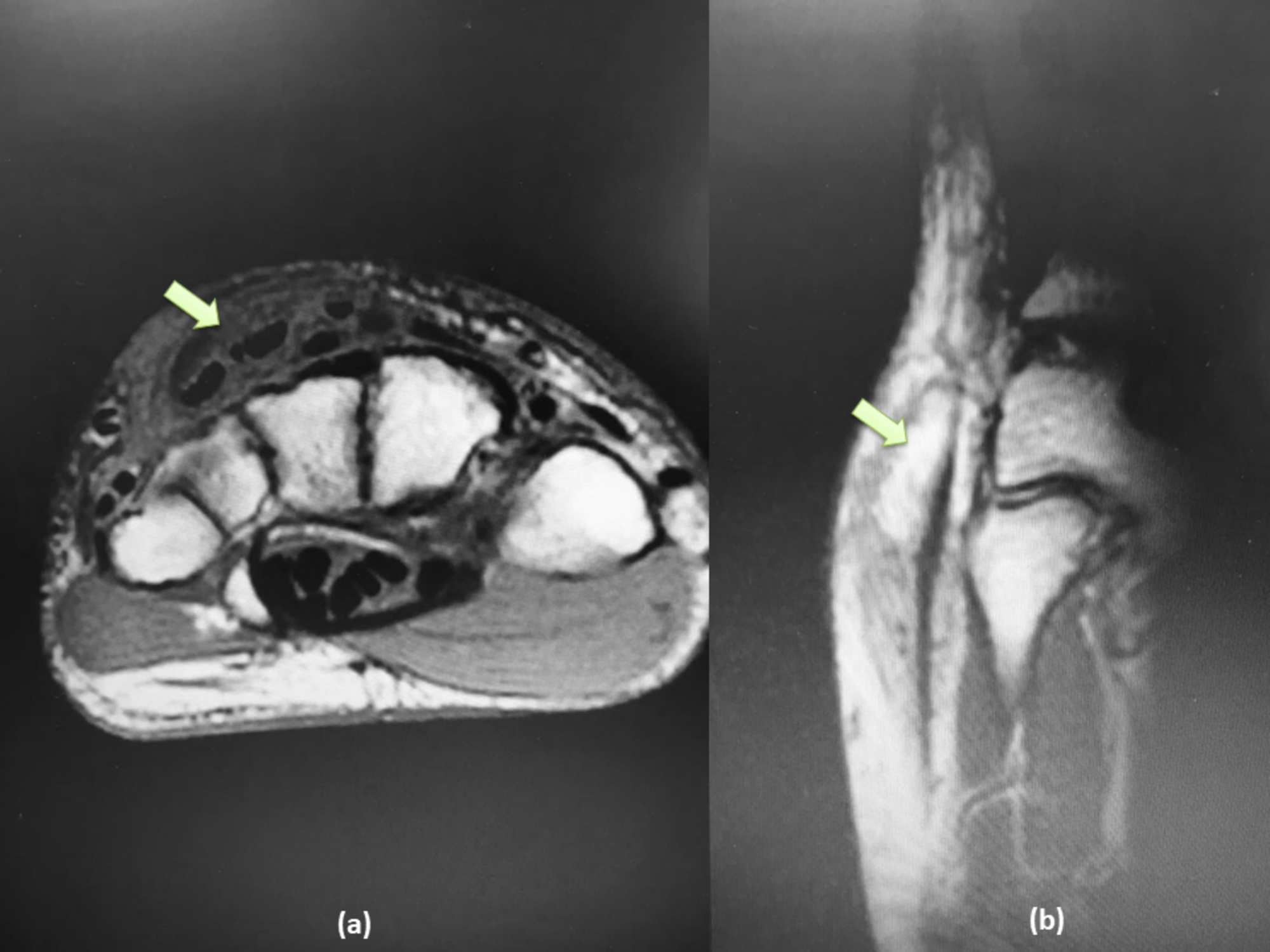 Cureus Tuberculous Extensor Tenosynovitis Presenting as Huge Mass on the Dorsum of the Hand