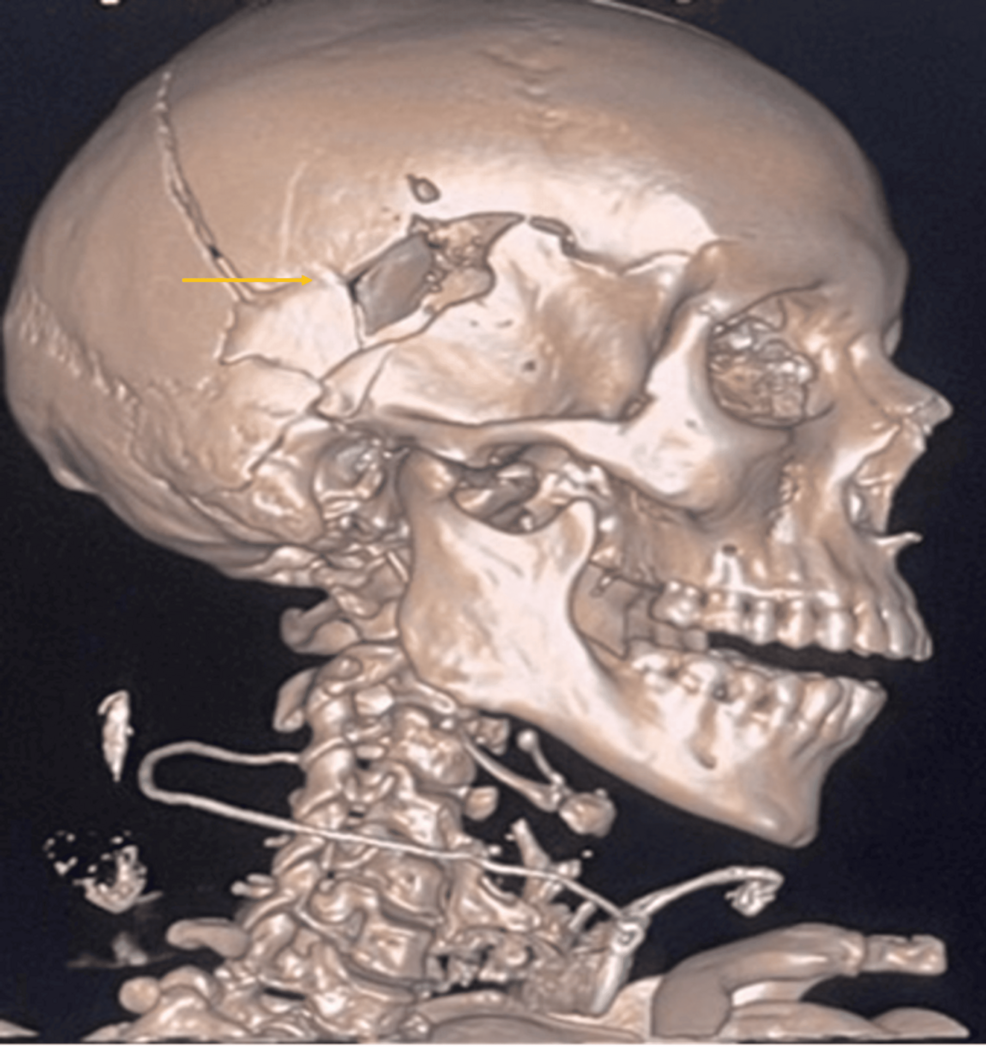 Firearm Suicide and Hormonal Imbalances: A Comprehensive Forensic Case Report and Literature Review