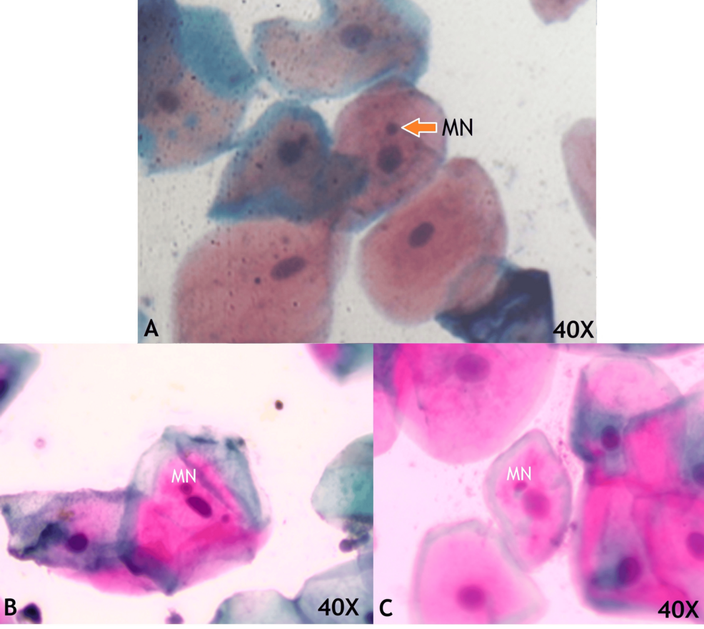 Exfoliated-buccal-mucosal-cells-in-medium-magnification-consisting-of-micronuclei-(MN)-which-are-small-rounded-smooth-periphery-and-same-staining-intensity-of-nuclei-in-COVID-19-negative-patients Exfoliated-buccal-mucosal-cells-in-medium-magnification-consisting-of-micronuclei-(MN)-which-are-small-rounded-smooth-periphery-and-same-staining-intensity-of-nuclei-in-COVID-19-negative-patients