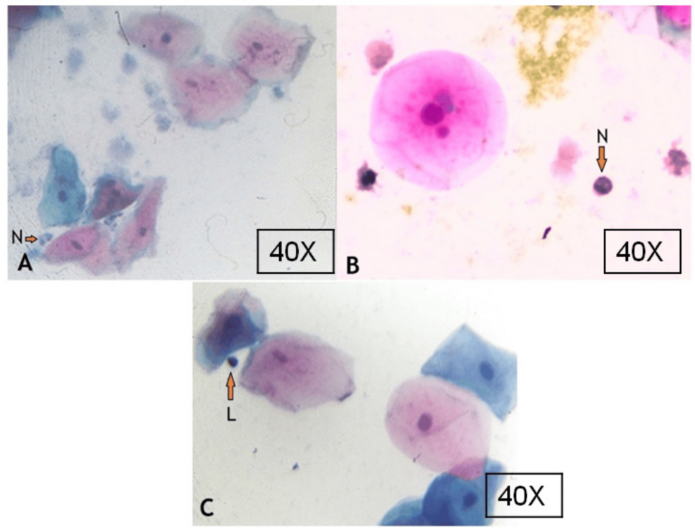 Buccal-smear-showing-buccal-cells-and-inflammatory-cells-in-COVID-19-positive-patients Buccal-smear-showing-buccal-cells-and-inflammatory-cells-in-COVID-19-positive-patients