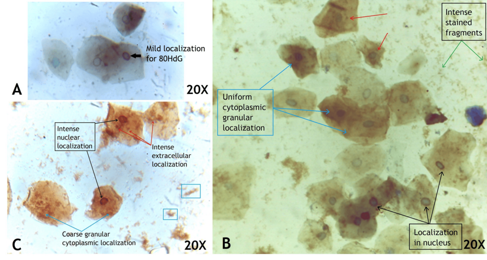 Buccal-cells-of-COVID-19-positive-patient-localized-for-8-OHdG-and-counter-stained-with-hematoxylin-showing-mild-(a),-moderate-(b)-and-intense-(c)-staining Buccal-cells-of-COVID-19-positive-patient-localized-for-8-OHdG-and-counter-stained-with-hematoxylin-showing-mild-(a),-moderate-(b)-and-intense-(c)-staining