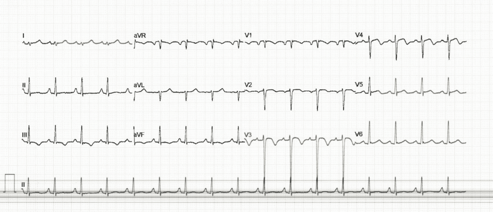 ECG-findings-of-the-patient