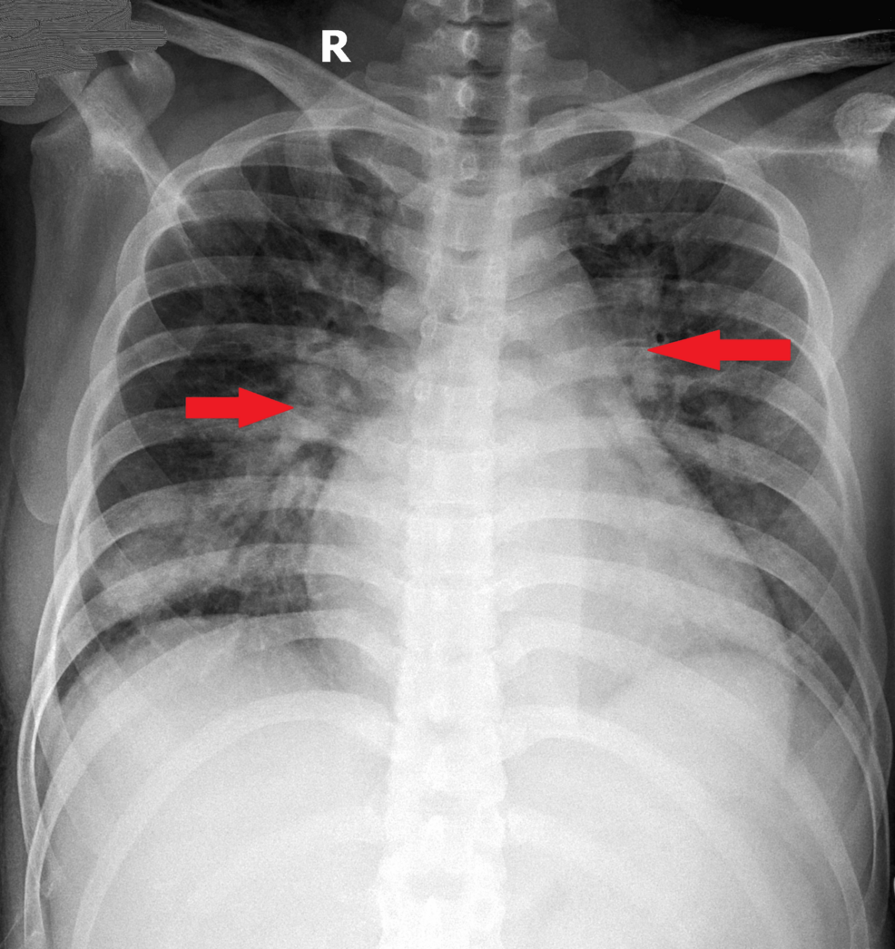 Chest-X-ray-showing-bilateral-perihilar-consolidations-(red-arrows)