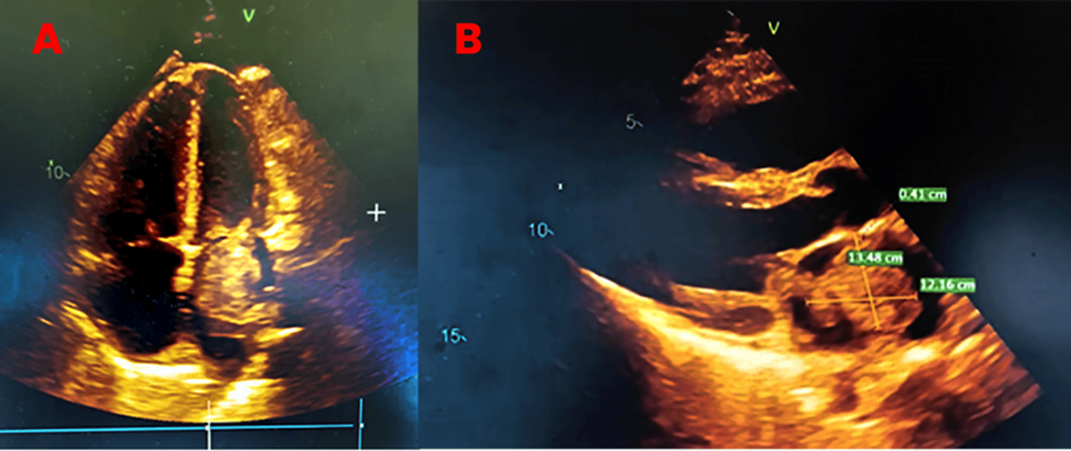 (A)-Transthoracic-echocardiography-showing-left-atrial-myxoma-prolapsing-into-the-mitral-valve;-(B)-measurement-of-left-atrial-myxoma-and-mitral-valve-obstruction-on-echocardiography