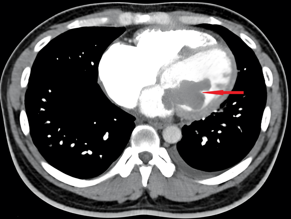 CT-scan-showing-the-presence-of-the-left-atrial-mass-prolapsing-into-the-left-ventricle-(red-arrow)