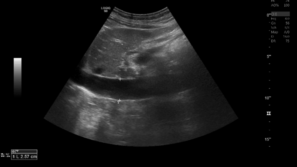 Abdominal-ultrasound-showing-mild-hepatomegaly