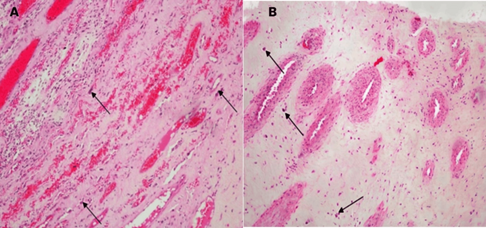 H&E-stain-of-the-histopathological-section-of-the-left-atrial-myxoma,-showing-polygonal-and-stellate-cells-in-myxoid-stroma-at-low-magnification-(A)-and-high-magnification-(B)-(black-arrows)