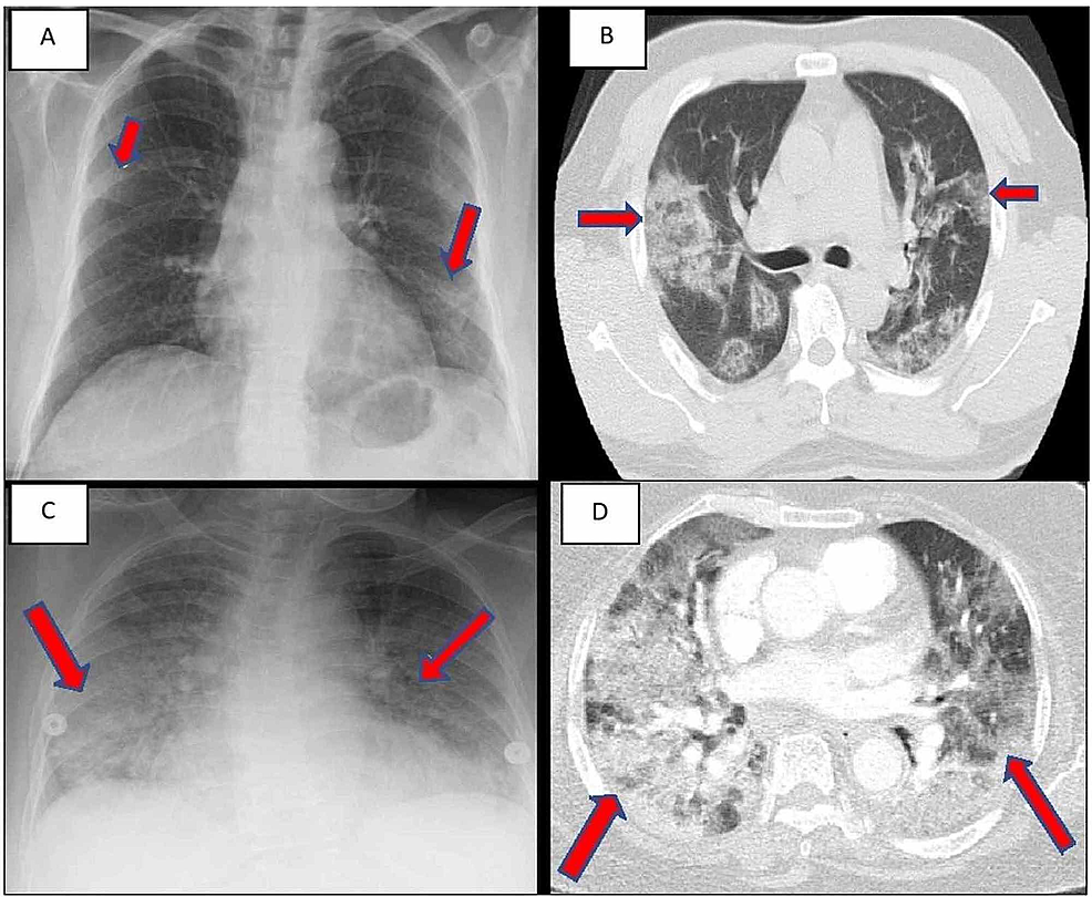 (A)-CXR-of-case-1-showing-bilateral-patchy-infiltrates.-(B)-CT-chest-of-case-1-showing-diffuse-scattered-areas-of-ground-glass-and-mixed-attenuating-opacities.-(C)-CXR-of-case-2-showing-multi-lobar-infiltrates.-(D)-CT-chest-of-case-2-showing-diffuse-bilateral-ground-glass-infiltrates.