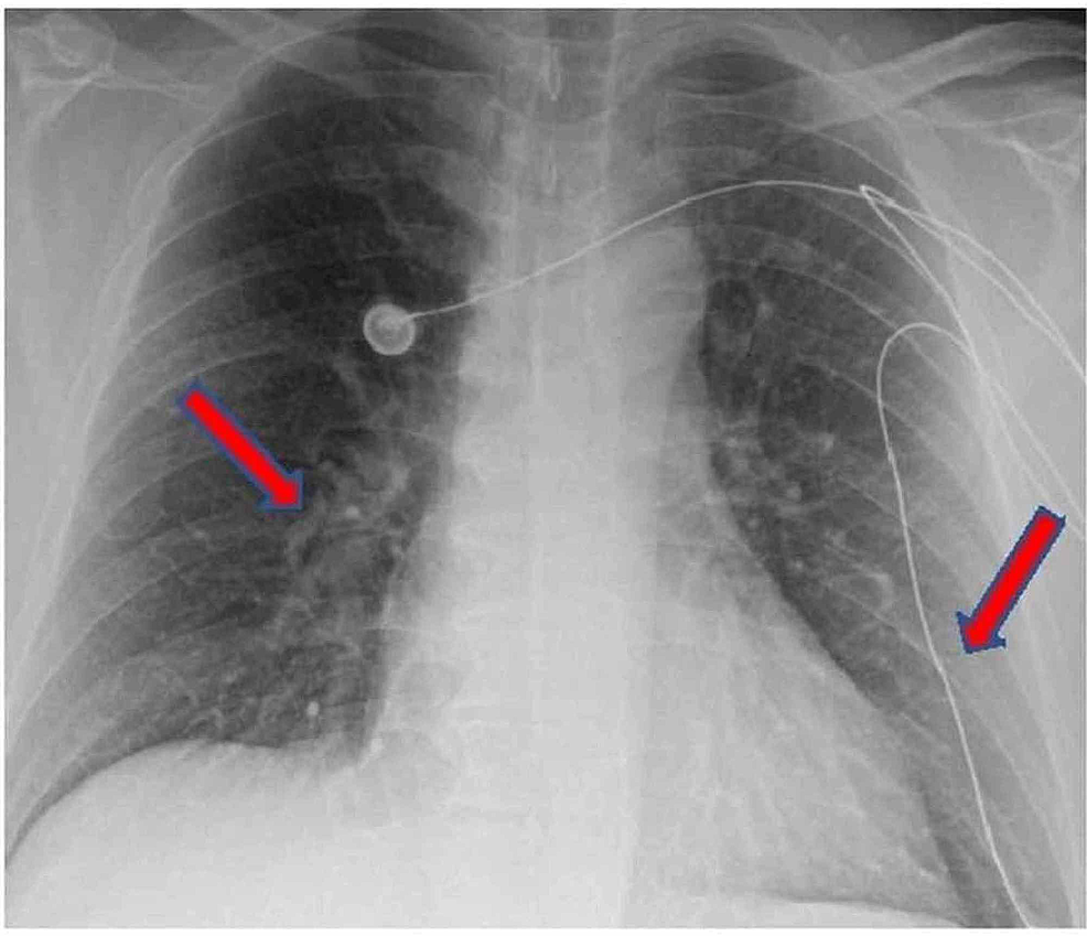 CXR-of-case-3-showing-bilateral-patchy-infiltrates.