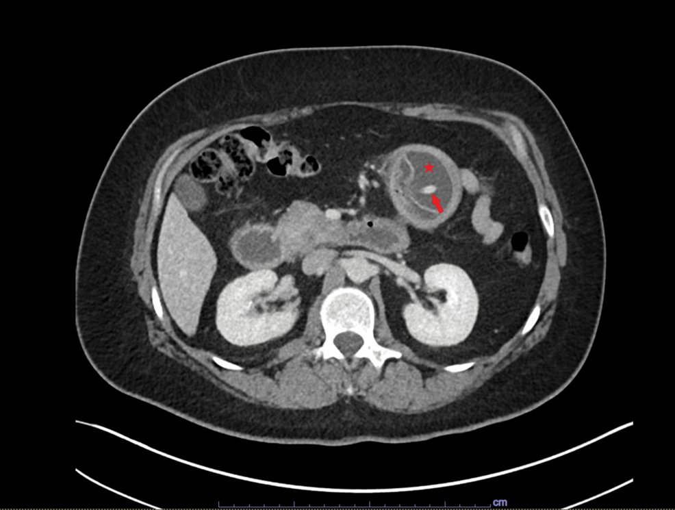 Endoscopic Retrieval of a Migrated Intragastric Balloon