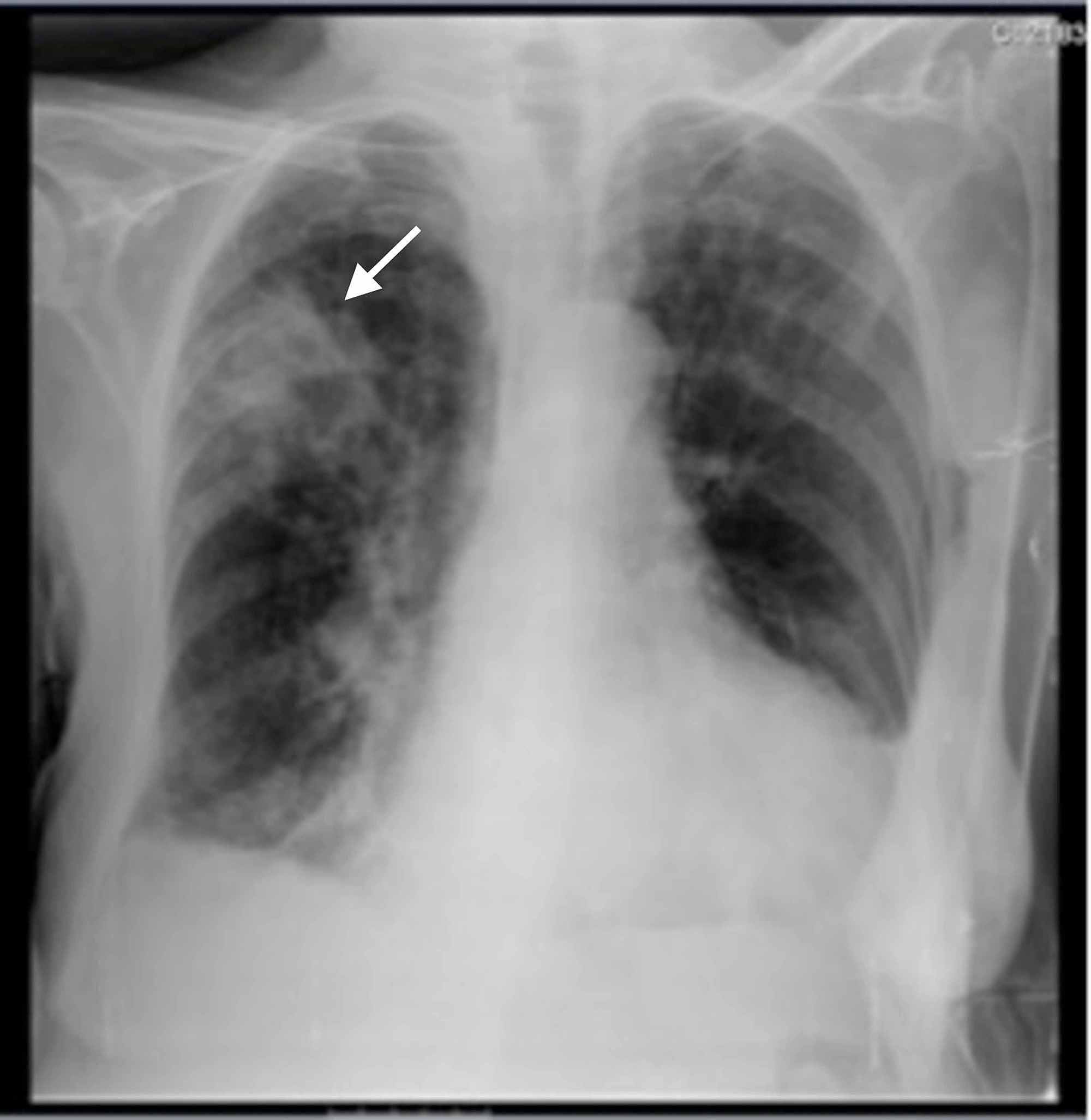 Cureus | Invasive Pulmonary Aspergillosis in an (Apparently ...