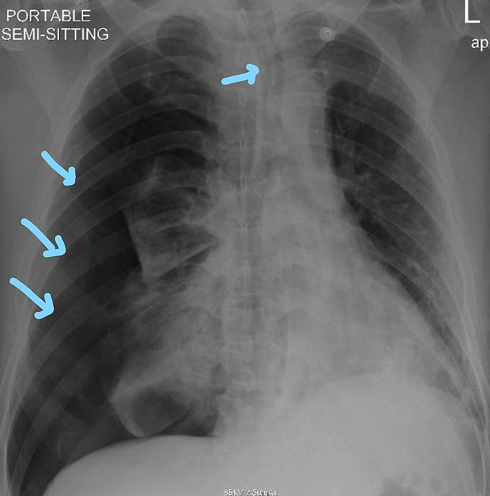 Cureus | Bilateral Hemopneumothorax in COVID-19