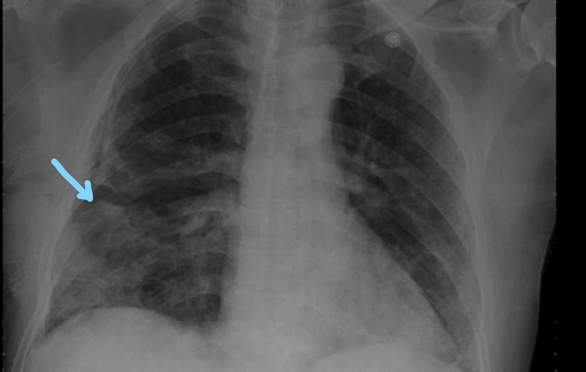 Cureus | Bilateral Hemopneumothorax in COVID-19