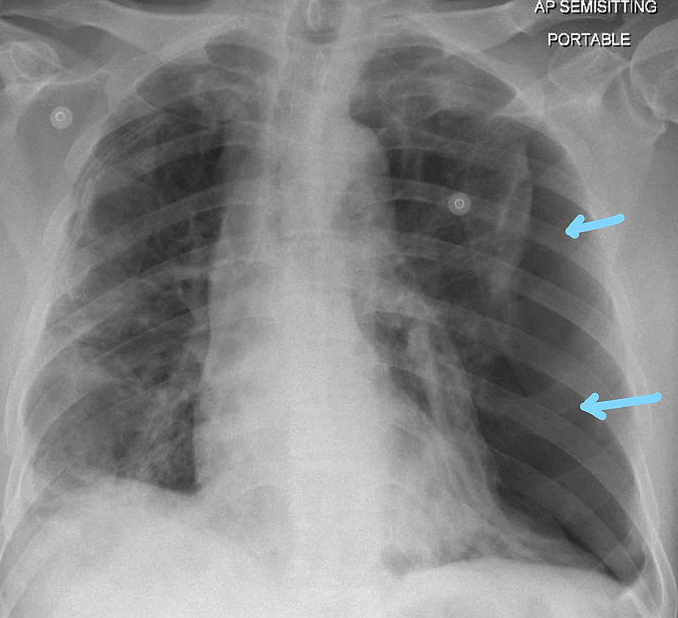 Cureus | Bilateral Hemopneumothorax in COVID-19