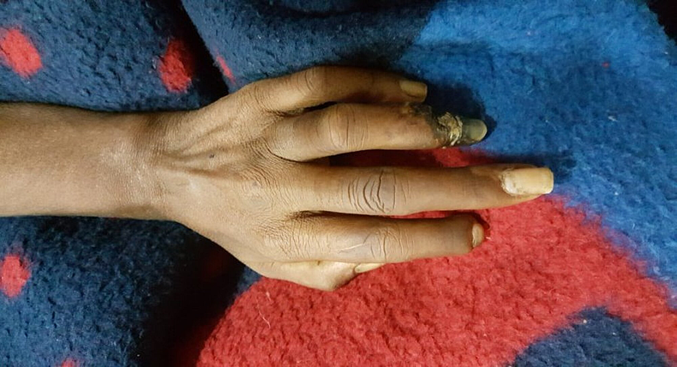 Cureus Autoamputation and Polyneuropathy in Mixed Connective Tissue