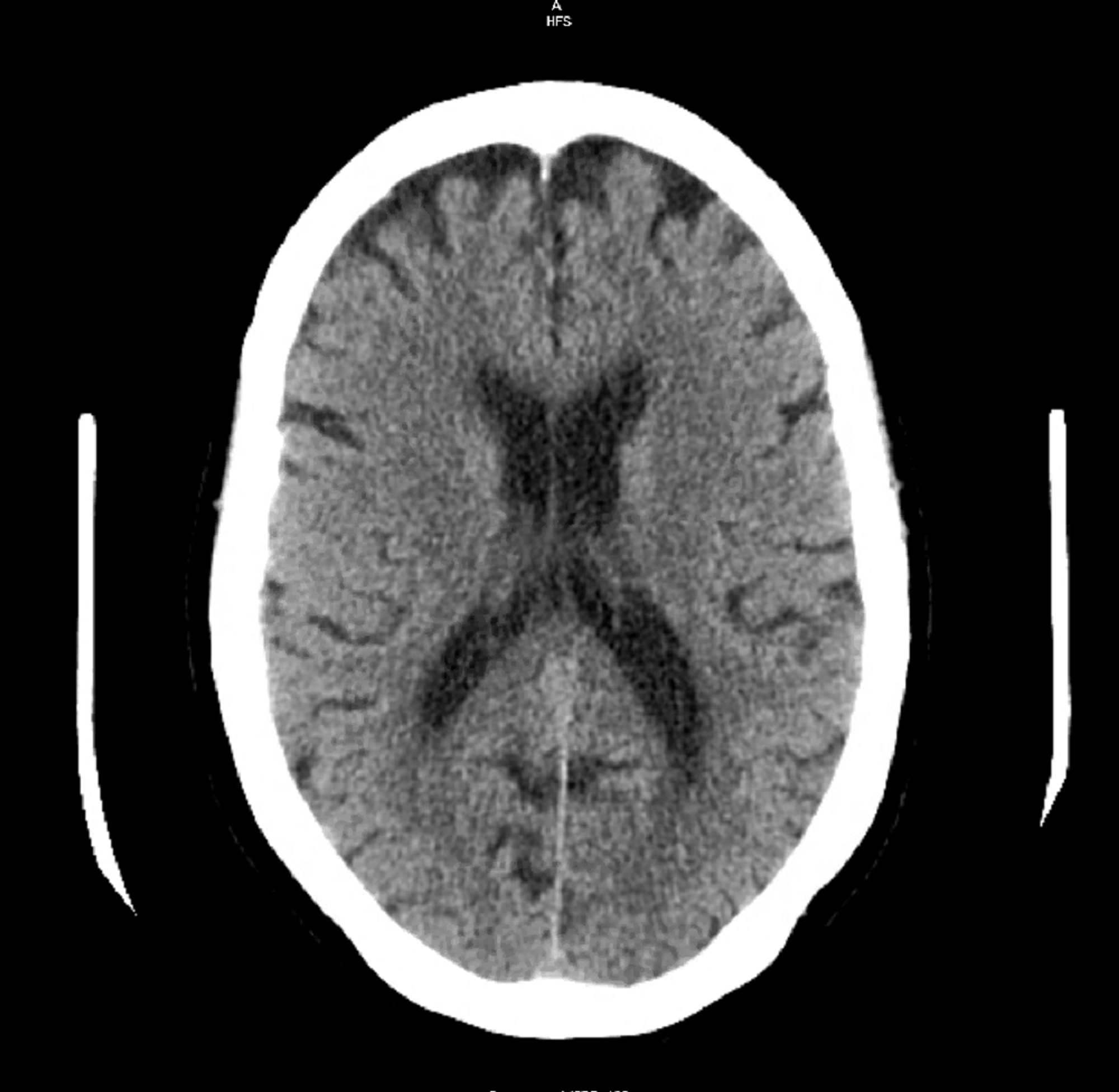 Cureus | Guillain-Barre Syndrome And Syndrome Of Inappropriate ...