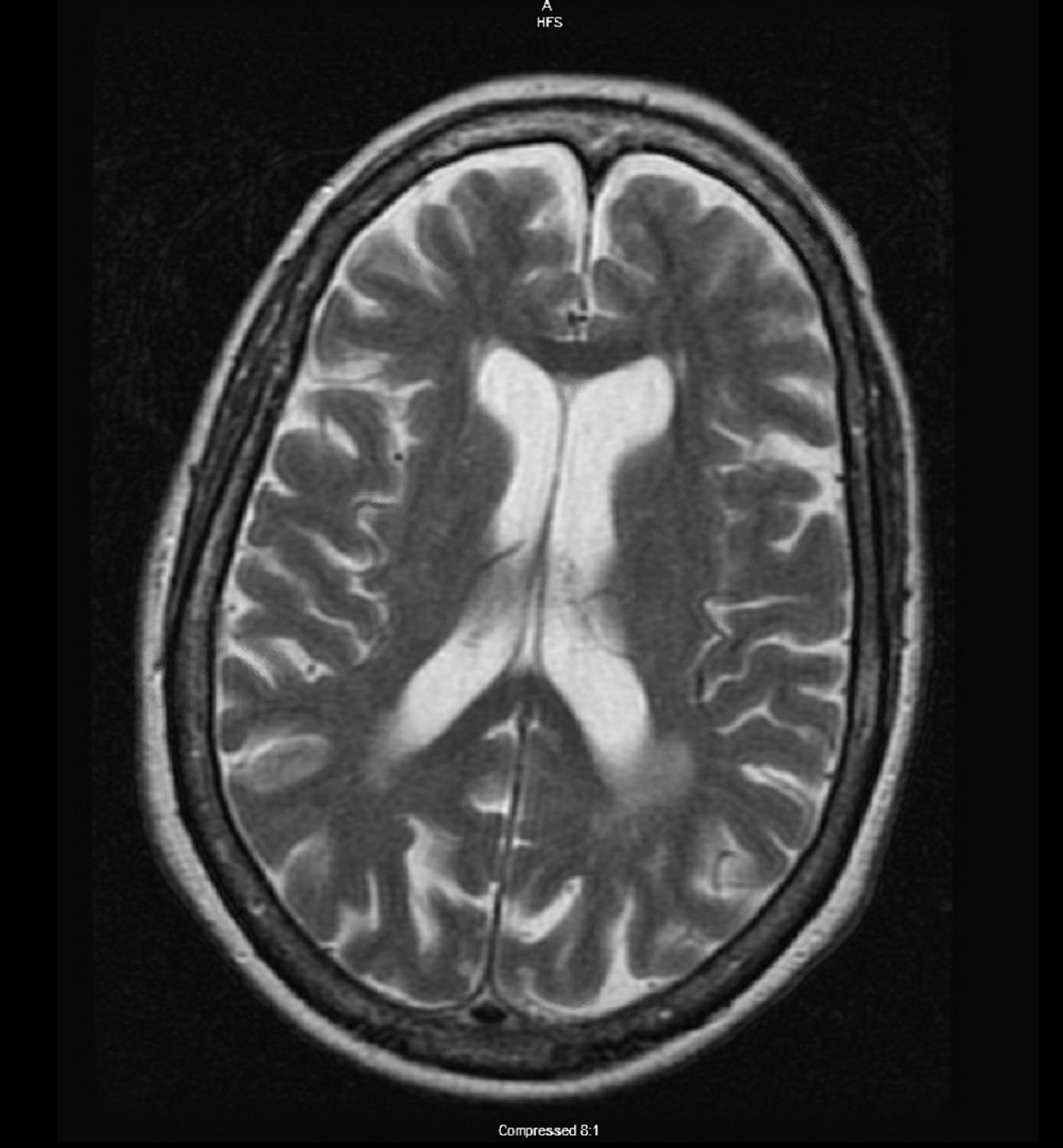 Cureus | Guillain-Barre Syndrome And Syndrome Of Inappropriate ...