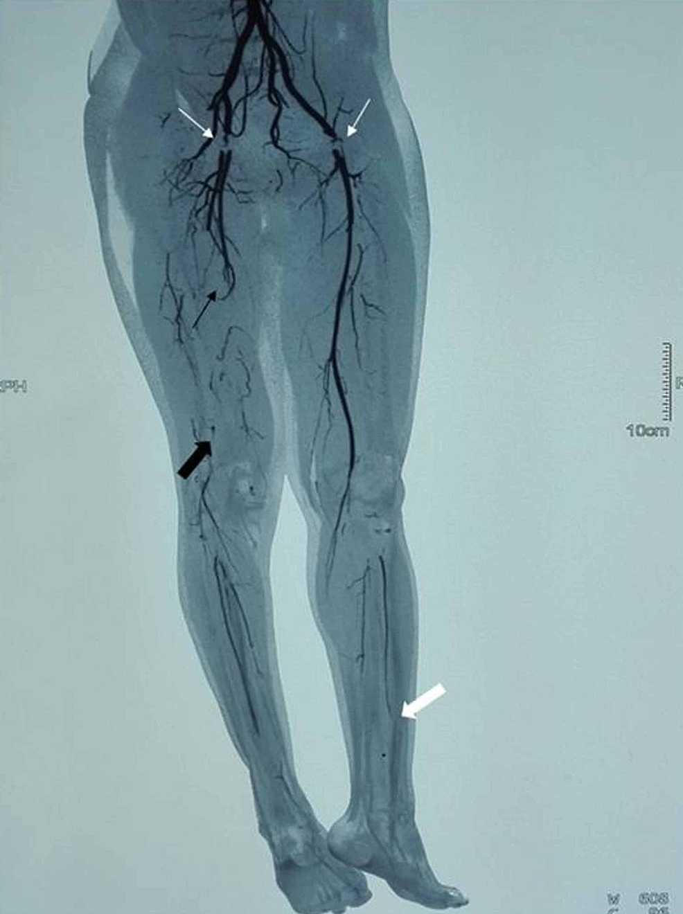 Transvenous CatheterBased Thrombolysis With Continuous Tissue