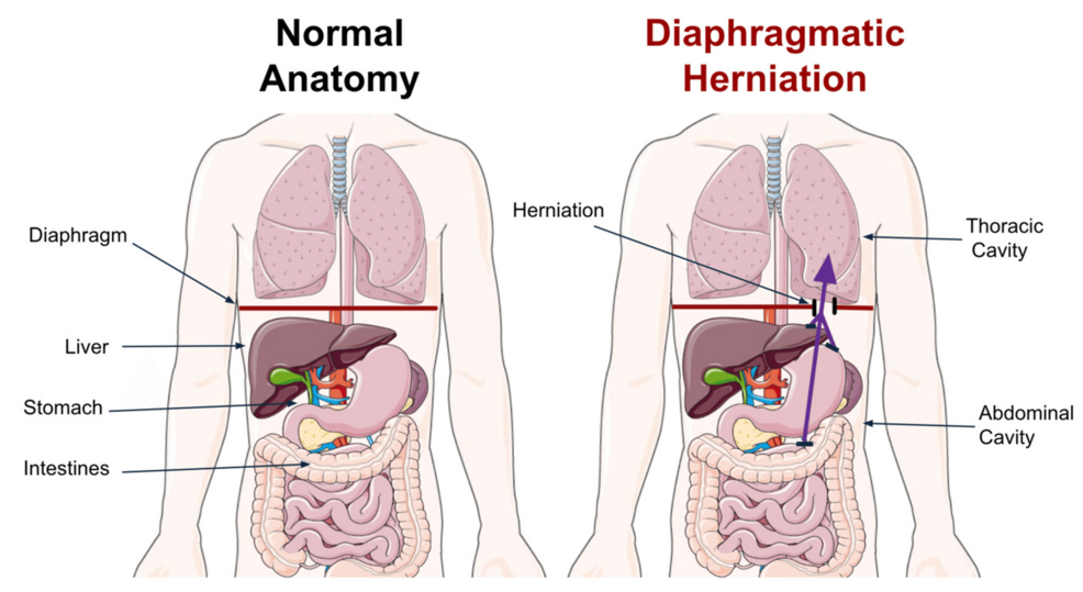 can bpc 157 heal hernia Today is two weeks after my double repair surgery. My once beautiful and flawless belly button is now mangled, bruised and deformed (as you see in the after picture). You BPC-157 vs TB-500 After Surgery