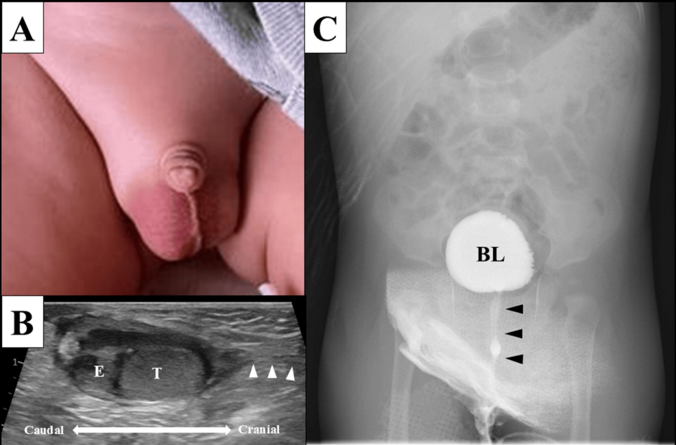Acute Infantile Epididymitis | epididymitis - Causes- Symptoms - Diagnosis - Best treatment | Homeopathic | Best Homeopathic Doctor in Pakistan | Dr Qaisar Ahmed MD, DHMS