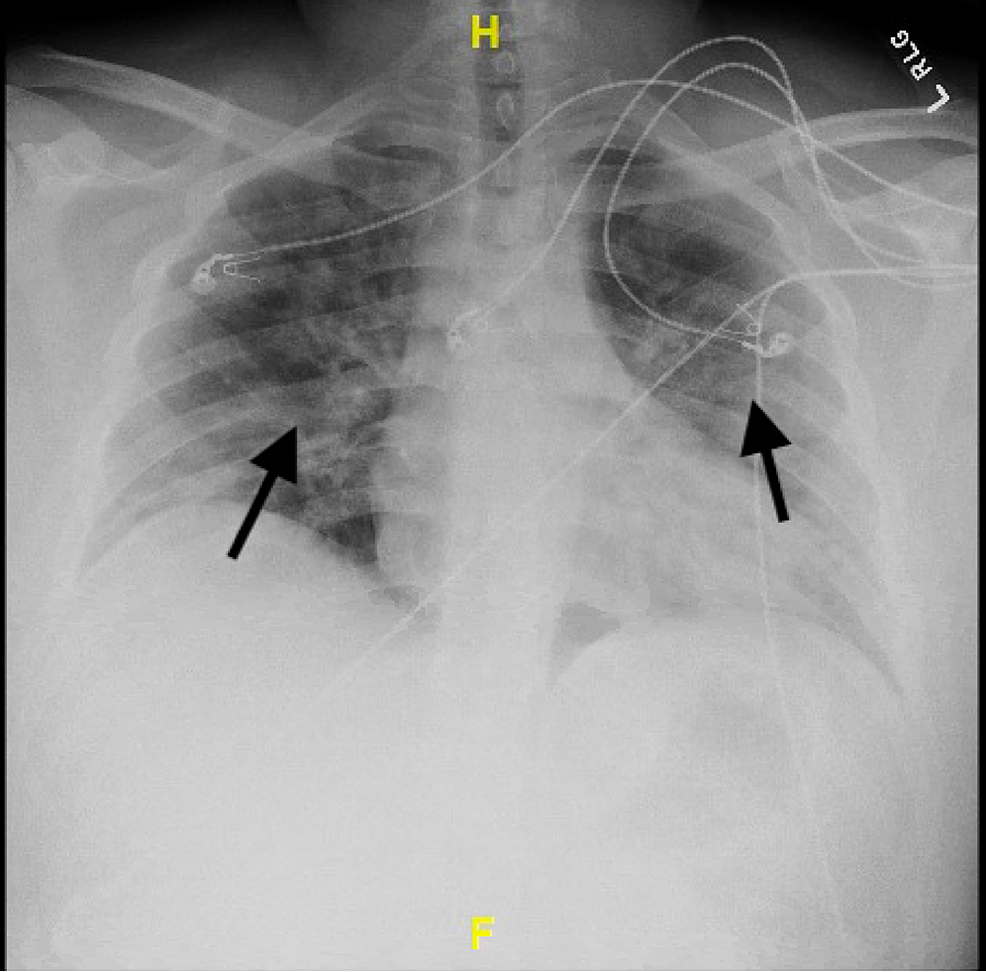 Cureus STElevation Myocardial Infarction in a 27YearOld Male With