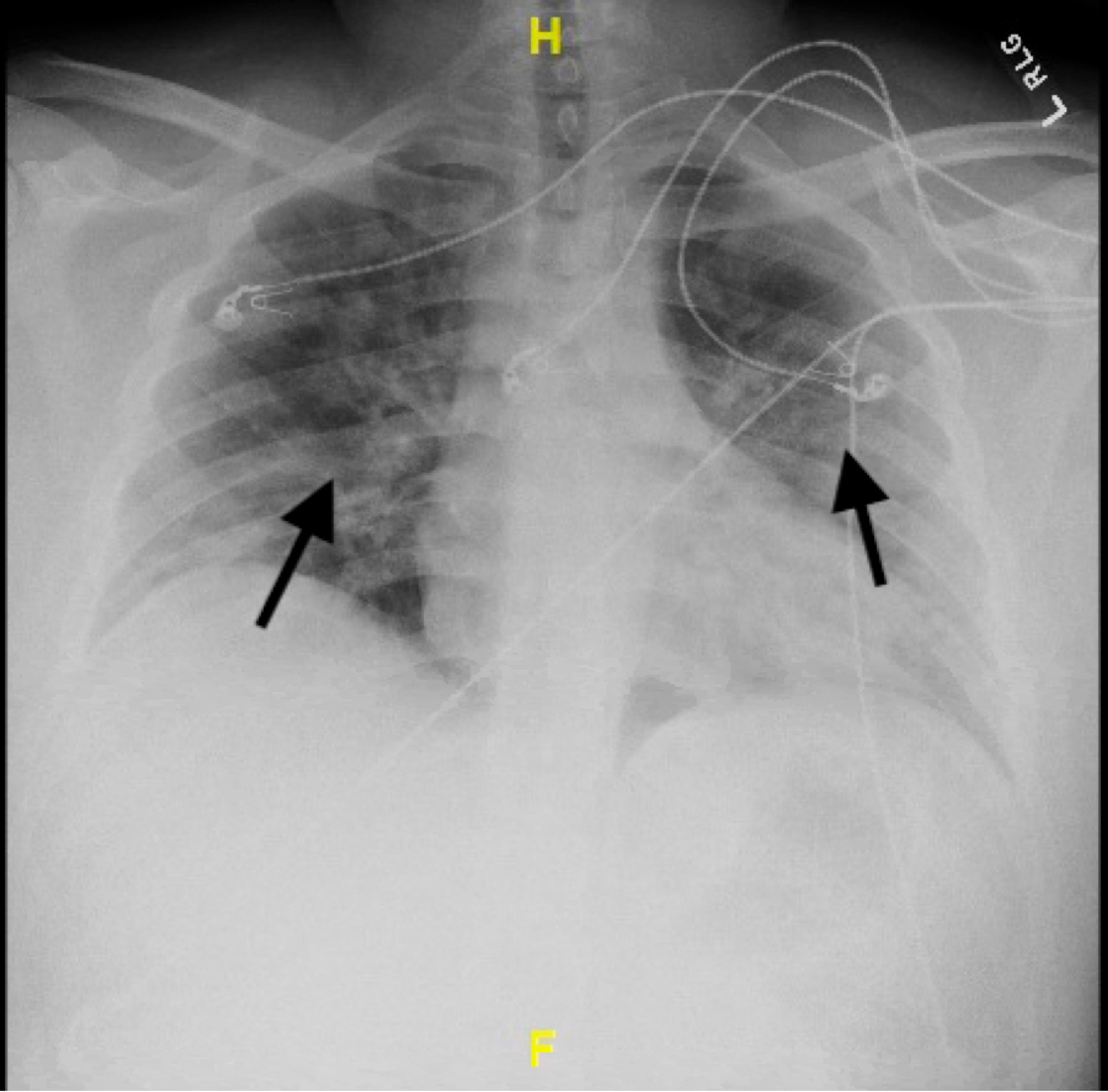 Cureus | ST-Elevation Myocardial Infarction in a 27-Year-Old Male With ...